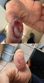 AMNIOTIC MEMBRANE "PATCHES"
