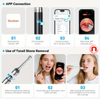 Smart kit for the visual removal of tonsil stones