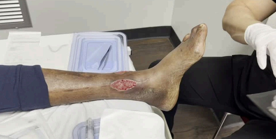 AMNIOTIC MEMBRANE "PATCHES"