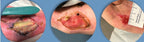 AMNIOTIC MEMBRANE "PATCHES"